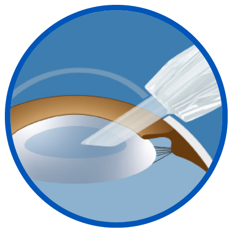 A diagram illustrating the insertion of an intraocular lens (IOL) into the eye. The image shows a close-up view of the eye with the IOL being placed in the capsular bag, the natural space behind the iris where the eye's natural lens was located.